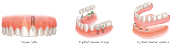 implants 1